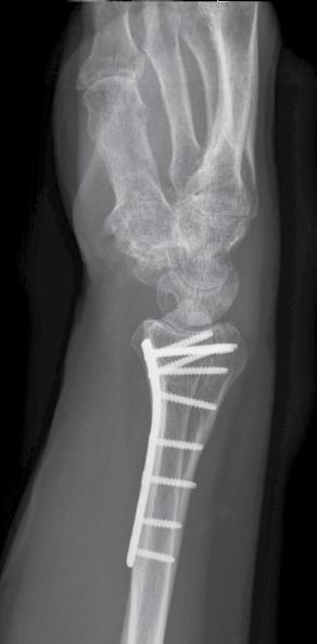 Following the exposure of the fracture site, the distal fragment was reduced and radial length was