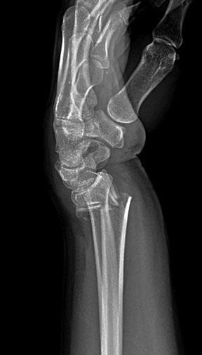 onto her outstretched hand. X-Rays indicated a displaced intra-articular 4-part left distal radius fracture and a non-displaced left ulnar styloid fracture.