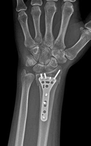 The D-RAD plate provided stable fixation of all fragments promoting fracture healing. At six weeks postop the patient was in the process of healing with satisfactory alignment.