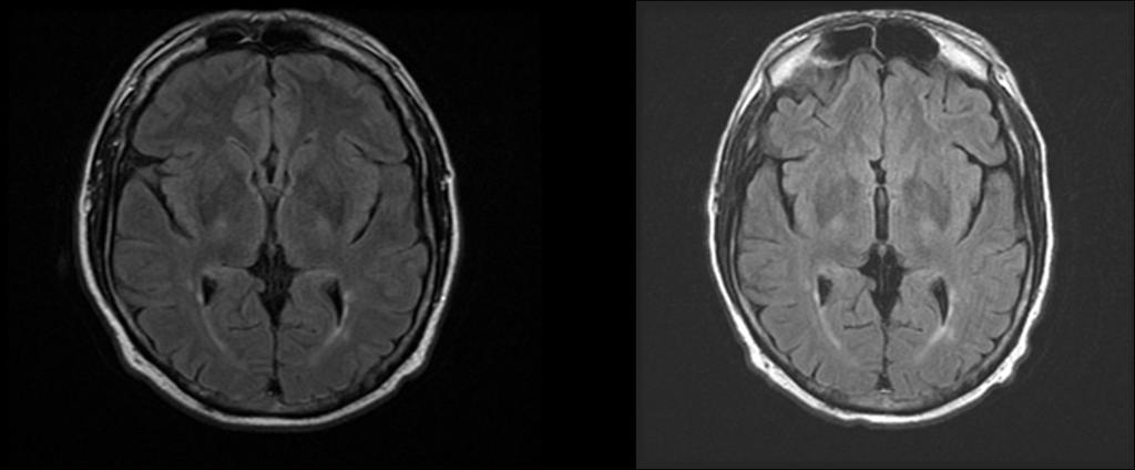 Figure 1: Left image dated April 2006. Right image dated September 2007. the brisk reflexes were explained by cervical pathology on MRI.