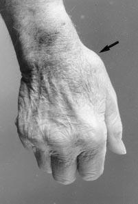 Journl of Orthopedic & Sports Physicl Therpy B A FIGURE 5. (A) A dorsl view showing erly stges of instbility of the crpometcrpl joint secondry to osteorthritis.