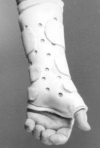 (B) The long opponens splint is shown for the person described in A. Note tht the wrist joint nd the crpometcrpl nd metcrpophlngel joints of the thumb re ll incorported into the splint.
