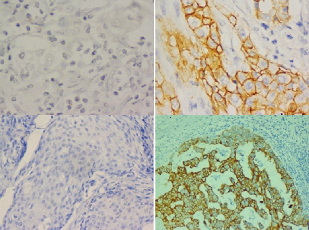 Clinico-pathological characteristics of high grade breast carcinomas A B C D Figure 1. (A) EGFR negative staining; (B) EGFR positive staining; (C) CK5/6 negative staining; (D) CK5/6 positive staining.