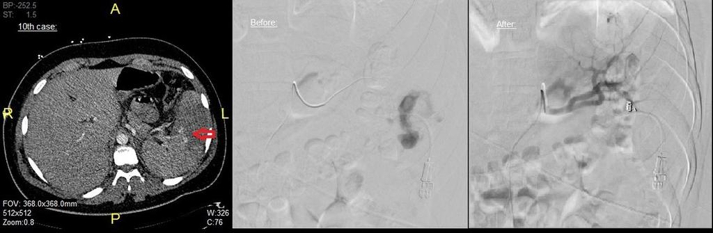 EMBOLIC AGENT: 3mm x 2 cm coils -POST EMBOLIZATION FINDINGS: Successful cessation of the bleeding. Fig.