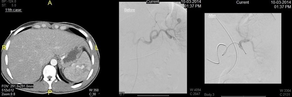 Fig. 11: 11th case:-ct FINDINGS: Splenic tear with evidence of splenic artery active extravasation/pseudo aneurysm.