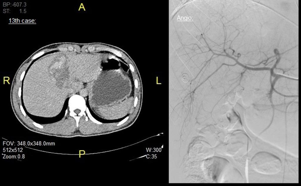 Fig. 13: 13th case: -CT FINDINGS: Large liver laceration with active arterial bleeding.