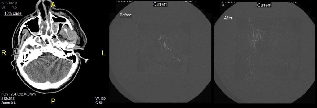 Fig. 15: 15th case: -CT FINDINGS: Multiple bony facial fractures. No active bleeding noted as no intravenous contrast was given. *24 hours, the patient developed bleeding from his nose and right ear.