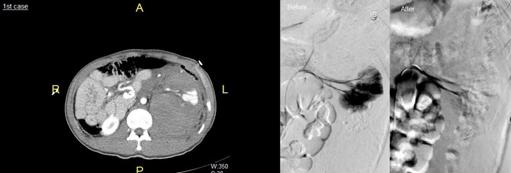 Fig. 1: 1st case: -CT FINDINGS: CT scan showed shattered kidney and active bleeding from left renal vessels.