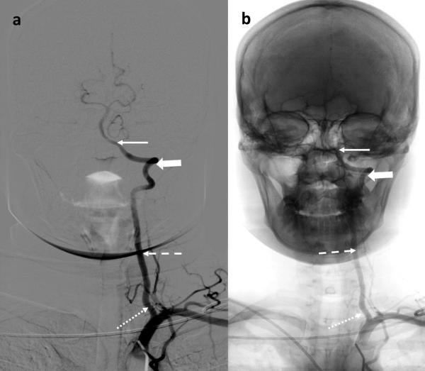 Duplication of origin of the right vertebral artery was found in one patient and anomalous origin of right vertebral artery from right common carotid artery (CCA) was found in another patient.