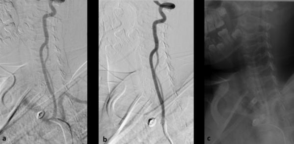 vertebral canal, depending on the level of occurrence. [8,9] The incidence of vertebral artery fenestration on autopsy and angiographic studies is 0.23%- [10,11] 1.95%.