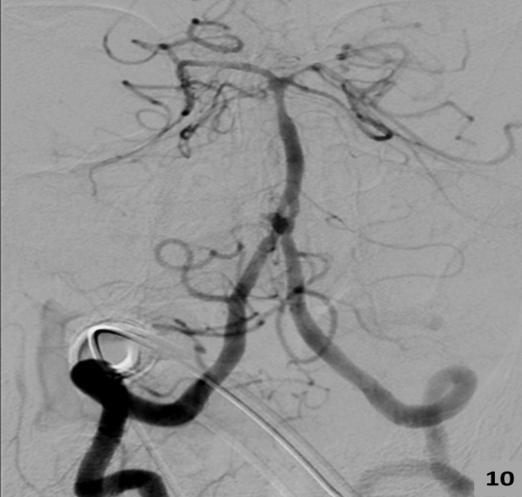 Fig 8: Left CCA injection (a) AP view, (b) lateral view, (c) unsubtracted lateral view show proatlantal intersegmental artery type II (black arrow). ICA (white arrow), ECA (open arrow).