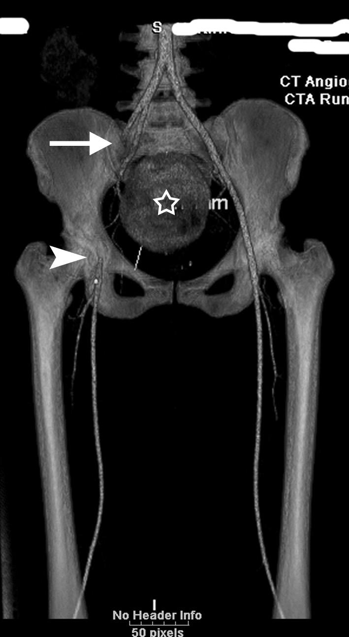 140 Vascular Medicine 16(2) Figure 9. A 61-year-old female with right-sided rest pain underwent a MDCTA.