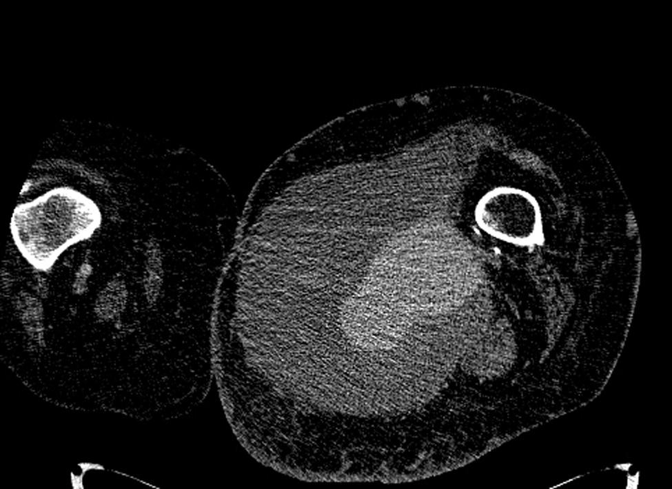 Note the almost concentric calcification within the left popliteal artery. (B) Dual-energy image of the same patient and at the same table position as Figure 1A, acquired at 140 kv.