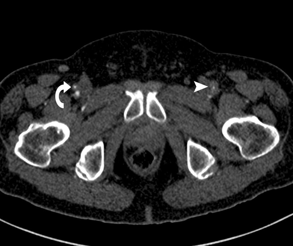 Keeling AN et al. 137 Figure 5A. A 72-year-old male presented with bilateral short distance intermittent claudication, worse on the left side.