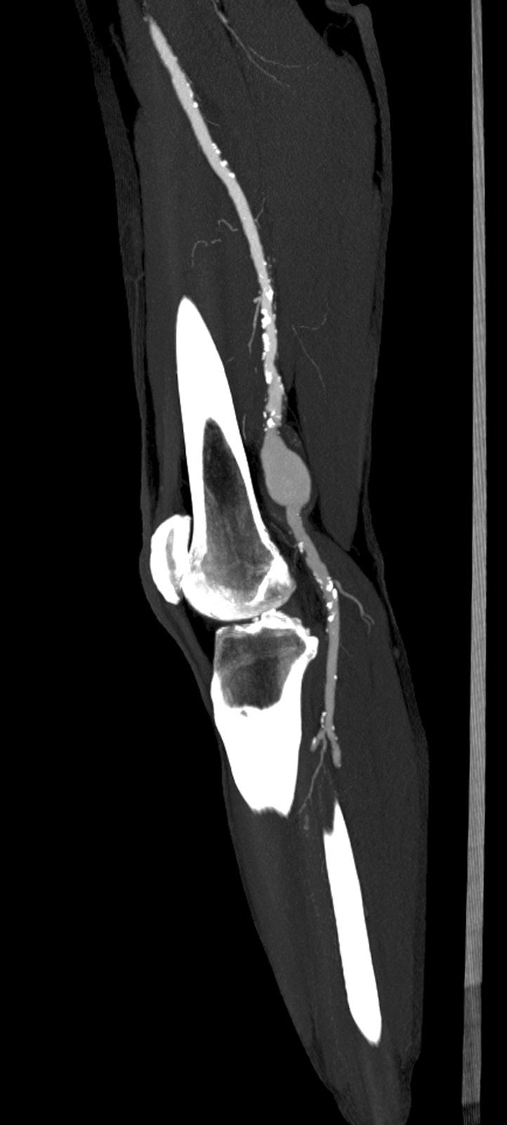 Keeling AN et al. 139 A B Figure 7. (A) A 69-year-old male with a swelling behind the right knee.