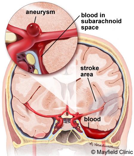 Subarachnoid Hemorrhage & Vasospasm basic level Overview Subarachnoid hemorrhage (SAH) is a serious, lifethreatening type of stroke caused by bleeding into the space surrounding the brain.