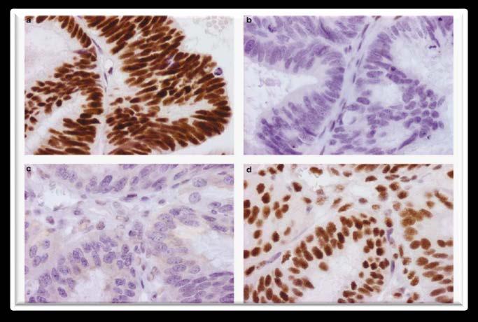 Mismatch Repair Deficiency (MMR-D): Unique Biological Subgroup of Colon Cancer IHC for MMR protein status MLH1+ MLH1-
