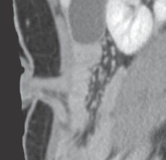 colitis. Minimal stranding (arrows) of subcutaneous fat is seen. Downloaded from www.ajronline.
