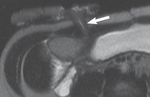 and, Normal appearance of loop ileostomy is seen on CT () and MRI () scans. Fig.
