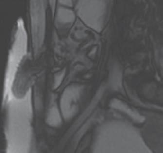 5 49-year-old woman with permanent end ileostomy performed 2 years before for ileocolic Crohn