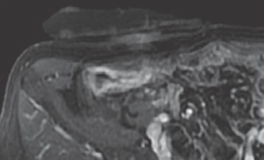 end ileostomy performed 23 years ago for Crohn disease.