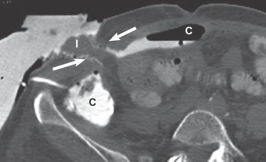 Thickening of distal ileum with edema of submucosa is related to radiation-induced enteritis. Fig.