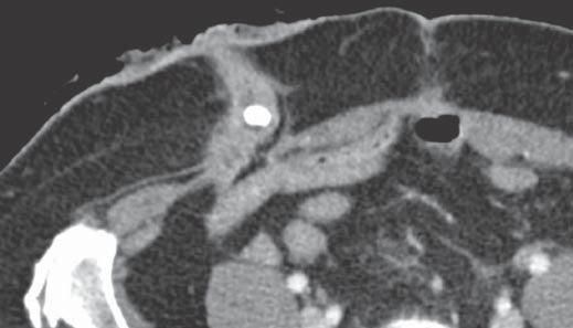 , Large retroperitoneal collection (asterisk) is seen.