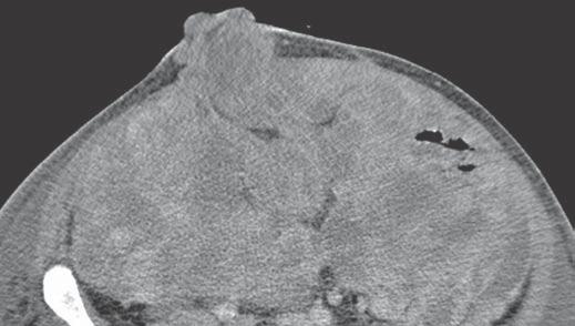 , Peristomal metastases are seen as round masses (arrows)., Two-month follow-up scan shows massive tumor recurrence. Fig.