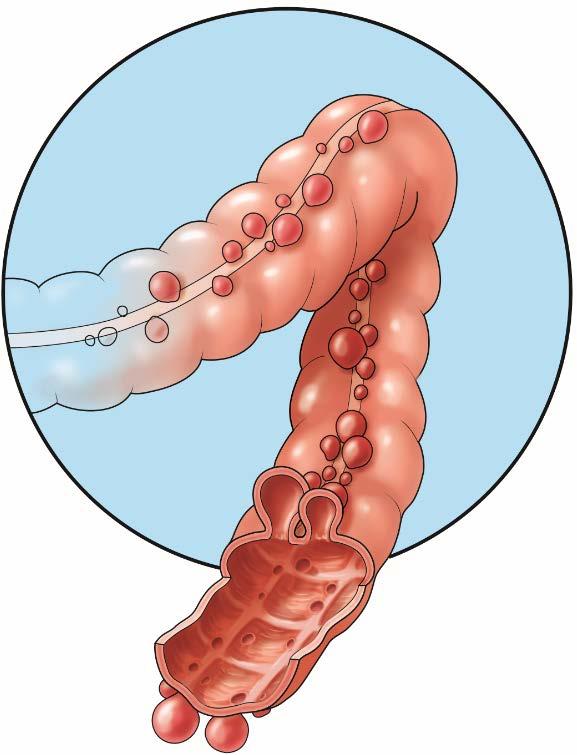 What Is Diverticulitis? By age 50, about half of people have diverticulosis, a health issue in which pockets (or diverticula) form in the wall of the large bowel.