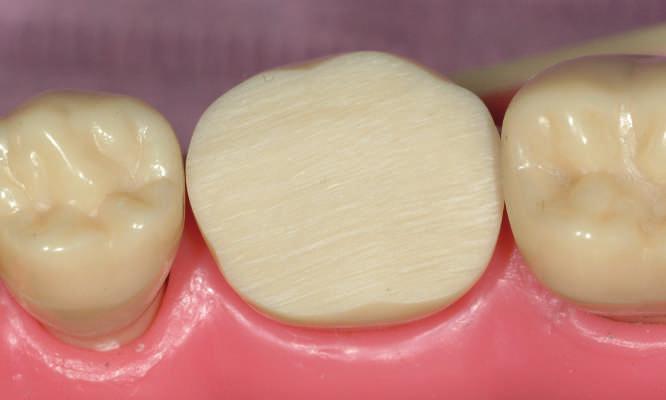 336 Operative Dentistry used are commonly used in amalgam restorations.
