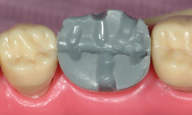 The occlusal third is ground down to allow enough room to prevent carving through the wax.