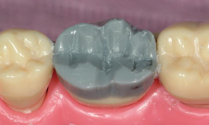 Lay an instrument across the cusps of adjacent teeth to find the appropriate level. Remove excess material, perpendicular to the long axis of the tooth, leaving flat surfaces at the cusp tips.