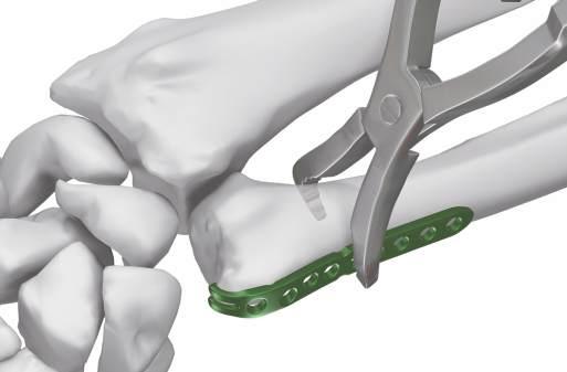 Patient Position The distal ulna should be placed in a supine position holding the
