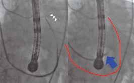 A Figure 3. The Carillon device has been placed in the coronary sinus with a distal anchor (white arrows) deployed in the distal part of the great cardiac vein (A).