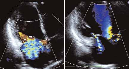 Figure 4. Color Doppler echocardiograms before (right) and 1 month after (left) implantation of a Carillon device, demonstrating a marked decrease in MR.