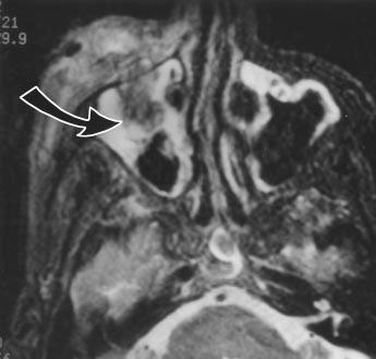 72-year-old man with nasopharyngeal carcinoma.