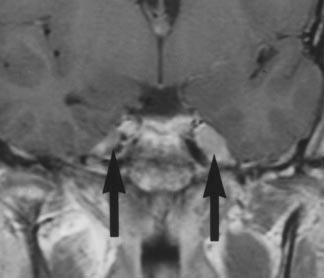 Trigeminal Nerve natomy Fig. 5. 15-year-old girl with known diagnosis of leukemia.