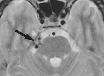 48-year-old man with pial arteriovenous malformation., Tangle of dilated blood vessels (arrow) at root entry zone of right trigeminal nerve on T2-weighted spinecho MR image.