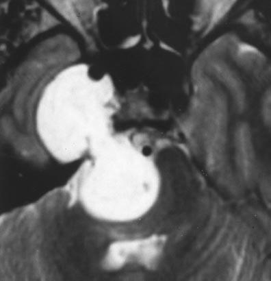 Note also early shunting into dilated draining vein (large arrow). Fig. 8. 56-year-old woman with petrous apex meningioma.