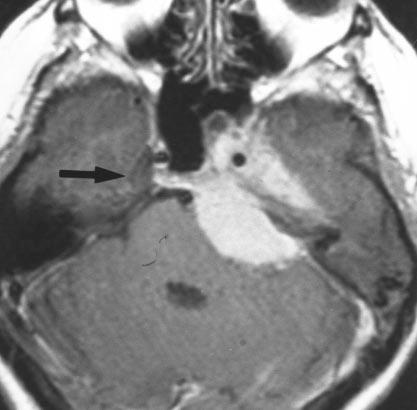 rrow indicates normal right-sided Meckel s cavity and dural tail on posterior surface of clivus. Fig. 9. 57-year-old man with trigeminal schwannoma.
