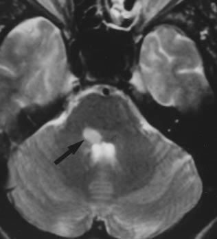 Trigeminal Nerve natomy Fig. 13. 45-year-old man with diagnosis of multiple sclerosis.