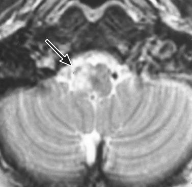 Note small area of high signal intensity adjacent to fourth ventricle and high signal intensity in white matter of temporal lobes. Fig. 14.