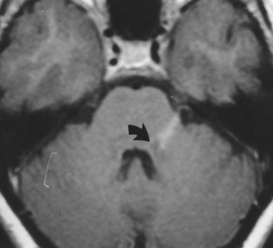 Localized high signal intensity caused by area of infarction on right side of medulla oblongata (arrow) on T2-weighted spin-echo MR image. Note absence of flow void in right vertebral artery.