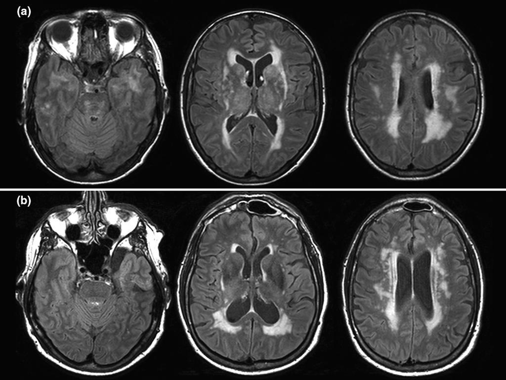 Differential Diagnosis Vascular parkinsonism: small vessel ischemic changes typically lower
