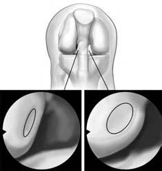 AM and IM PL Figure 2. Tunnel locations in the femoral footprint of the right knee.