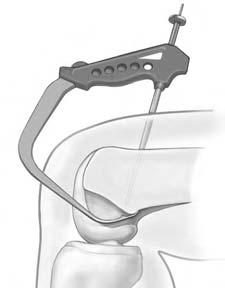 The Smith & Nephew Anterolateral Entry Femoral Aimer with 6 mm Offset Tip (REF 7210984) (Figure 5), combined with the view of the offset tip via the AM portal, makes it possible to consistently
