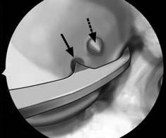 Femoral Tunnel Preparation Remove the residual fibrous tissues on the femoral ACL footprint via the AM portal. A notchplasty or wall plasty will not be required.