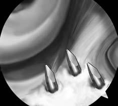 Figure 13. An arthroscopic view of the tibial footprint through the AM portal. Note three parallel guide pins forming an isosceles triangle. The distance between the two anterior pins is 7.