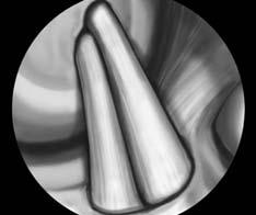 PL Graft Passage Use a 2.7 mm passing pin through the AM portal to insert a passing suture through the PL femoral tunnel. Use grasping forceps to retrieve the sutures through the PL tibial tunnel.