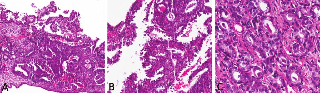 8,68 The histologic features and immunostaining pattern of cervical serous ADC are indistinguishable from serous tumors of the upper genital tract, and therefore assignment of the primary site has to